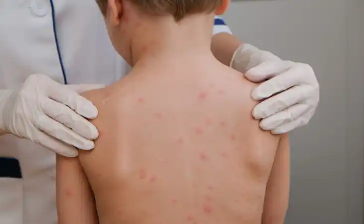 مكافحة حشرة الفراش 01050003433 كيفية التخلص من البق وطرده نهائيا من المنزل